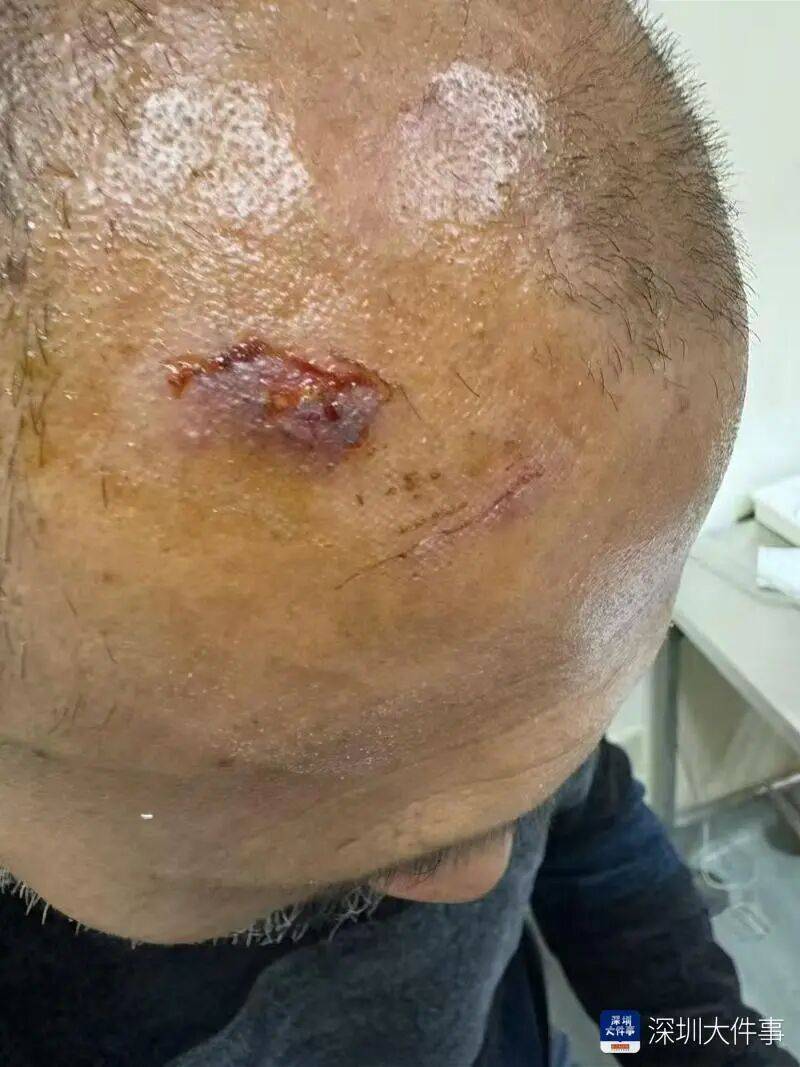 “影响我的形象”！一男子在深圳湾遭遇意外，头皮被戳破！部门回应